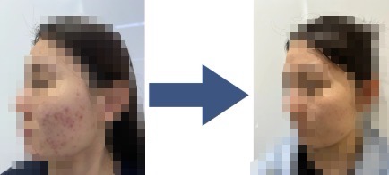 여드름 이미지